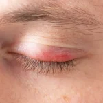 blefaritis por causas emocionales y ojo con herida