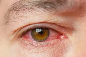 blefaritis por causas emocionales y ojo irritado